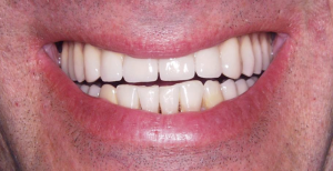 Mouth After Dental implant treatment Case 3 