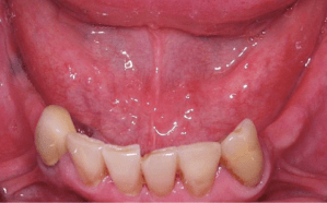 Mouth Before Dental implant treatment Case 3 