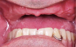 Mouth Before Dental implant treatment Case 3 
