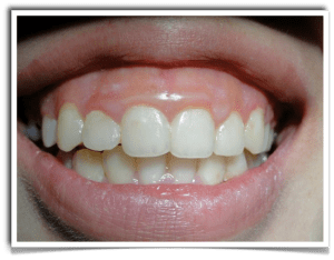 After image of smile before gummy smile correction